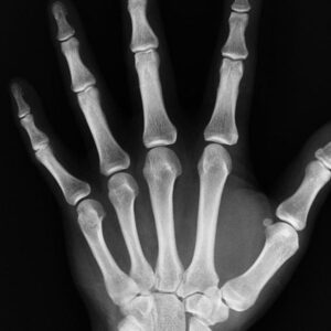 Radiografia de mão mostrando os ossos e articulações